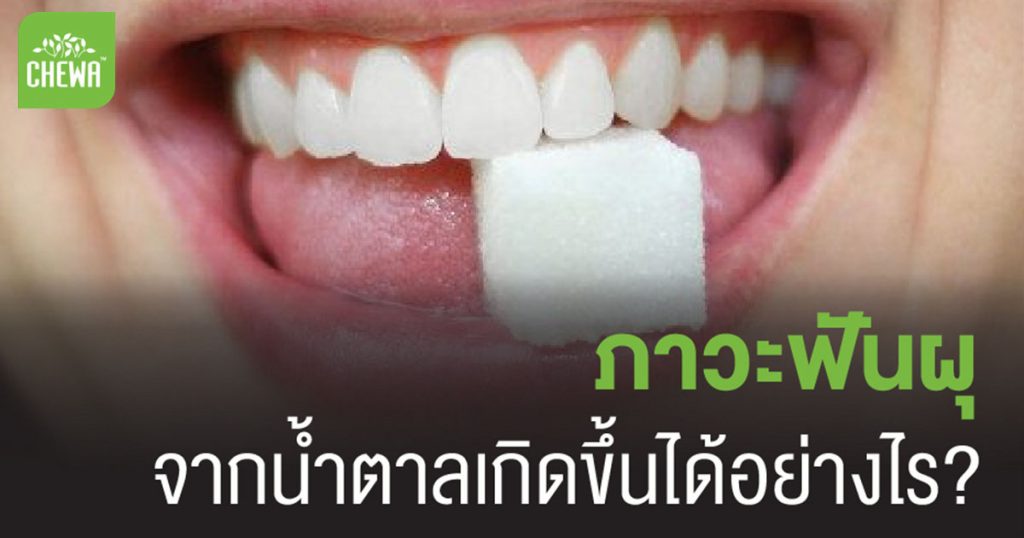 ภาวะฟันผุ เกิดจากน้ำตาล เกิดขึ้นได้อย่างไร