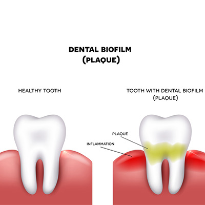 ภาวะฟันผุที่เกิดจากน้ำตาล ฟันผุระยะแรก