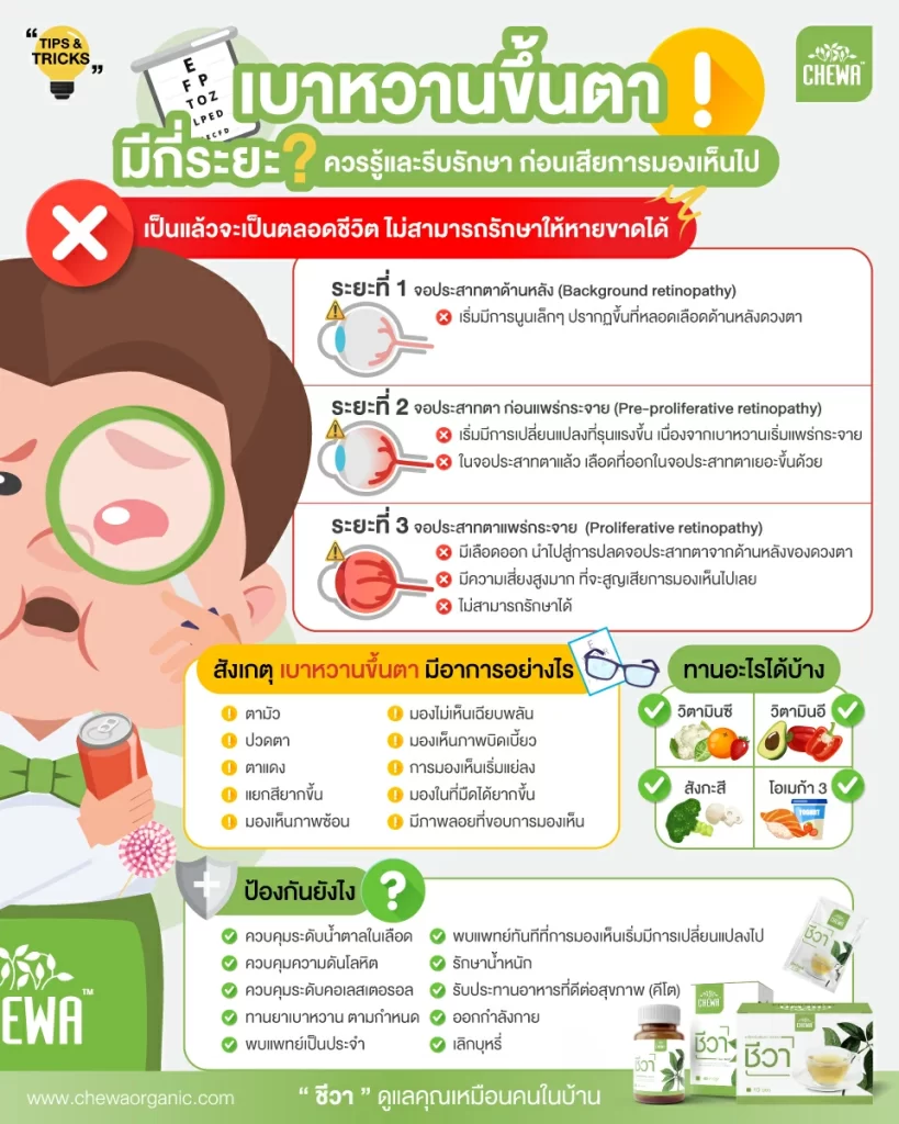 สรุป เบาหวานขึ้นตา มีกี่ระยะ ควรรู้และรีบรักษา ก่อนเสียการมองเห็นไป